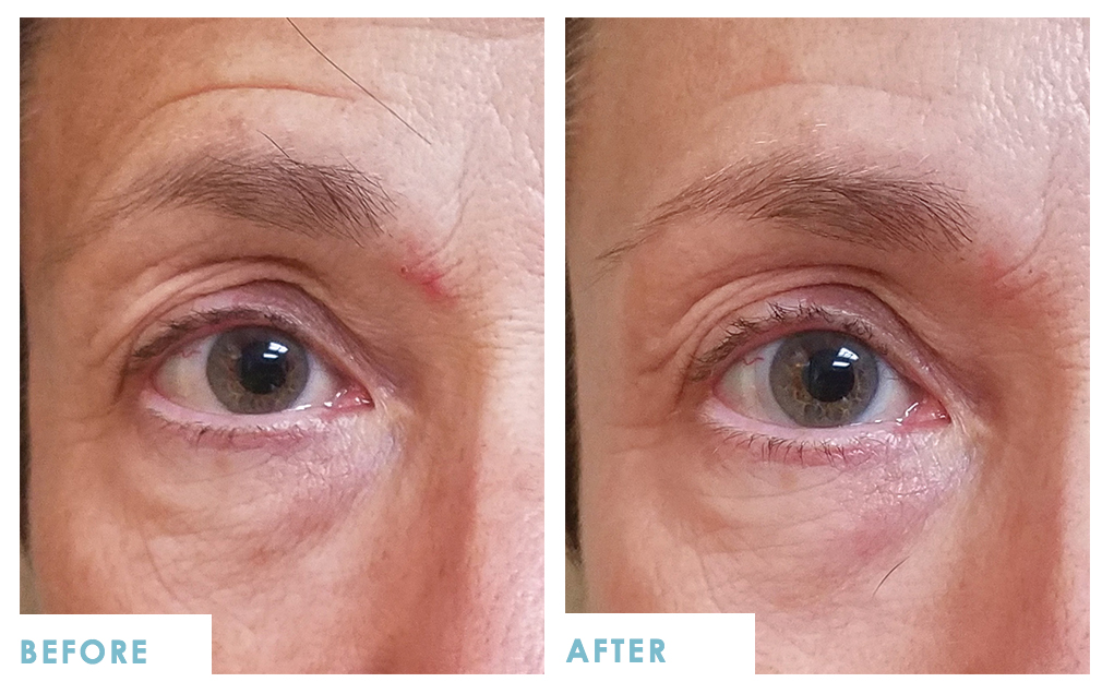 Eye Bags Treatment  Eden Skin Clinic Wimbledon & Kensington